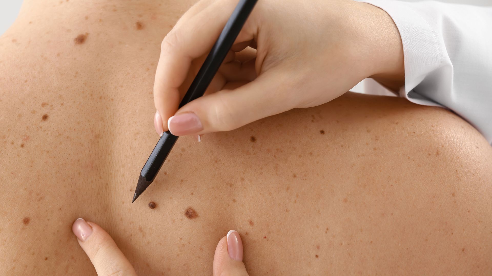 médico revisa lunares en la piel